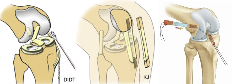 Docteur Thibault VERMERSCH - Reconstruction ligaments croisés